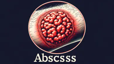 Absceso